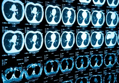 ct scan lung covid-19 pneumonia coronavirus pandemic sars-cov-2 ground glass opacity